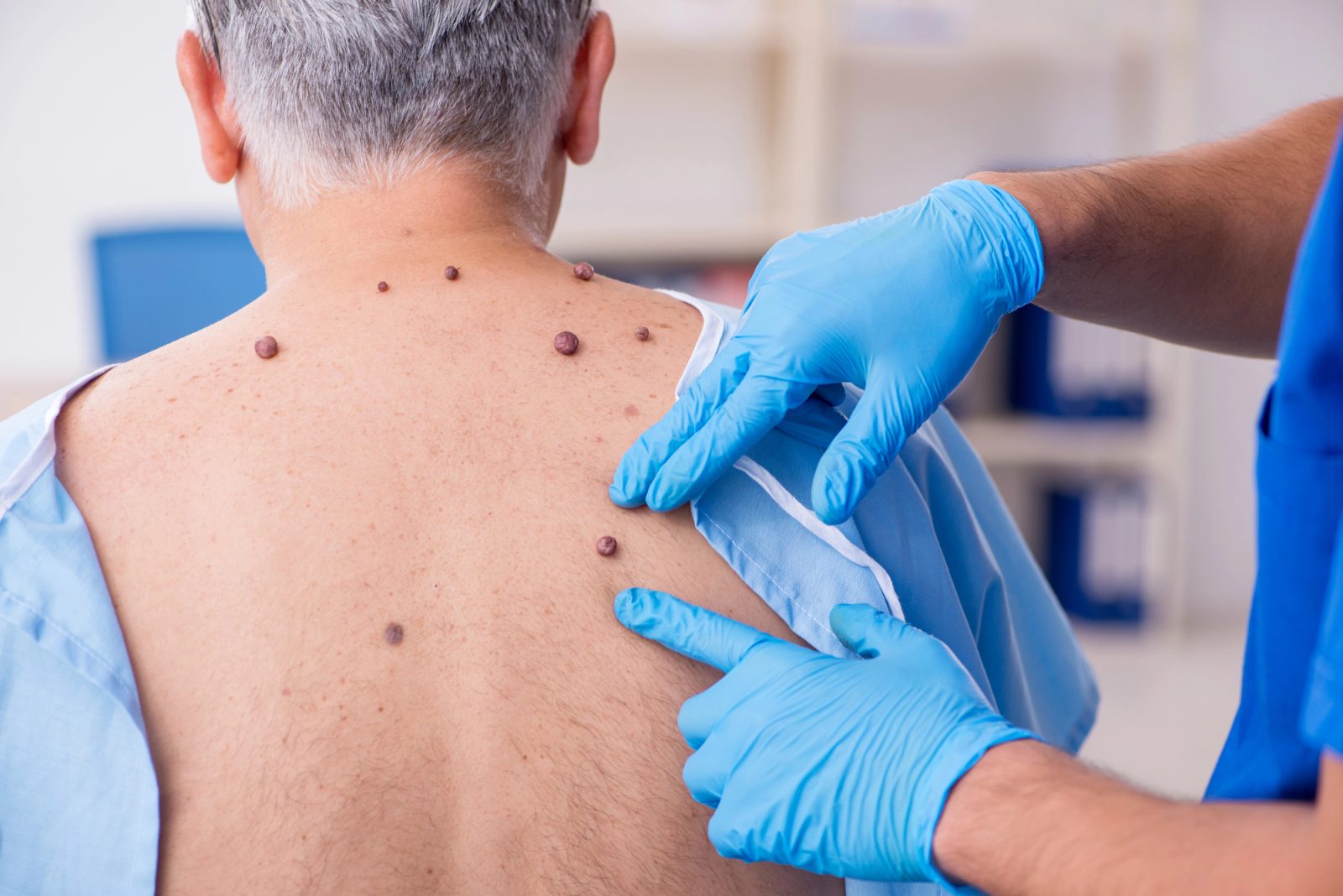 Odstranjevanje bradavic mi je izboljšalo življenje